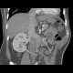 Polar artery, accessory renal artery: CT - Computed tomography